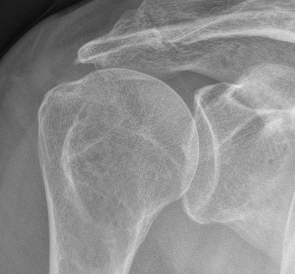 Humeral Head Superior Migration